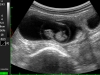 38 día del preñez en vaca- ecógrafo con la sonda rectal convexa